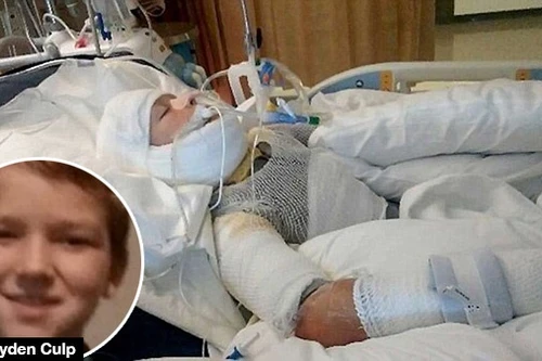 Mỹ: Bé trai 10 tuổi bị bạn tưới xăng đốt