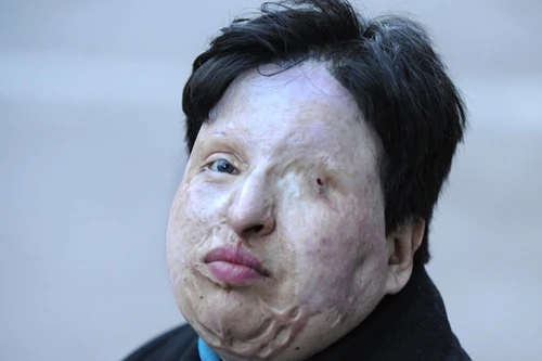 Hình phạt chấn động: Tạt axit vào mắt thủ phạm tấn công bằng axit