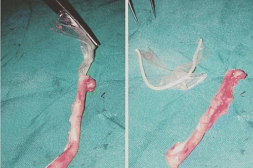 Mổ ruột thừa, tìm thấy bao cao su mắc kẹt trong bụng