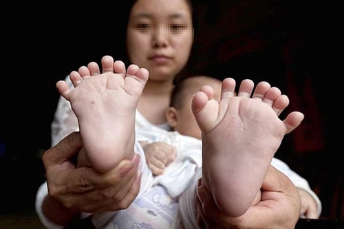 Cha mẹ tuyệt vọng xin giúp đỡ cho con trai có 31 ngón chân, tay