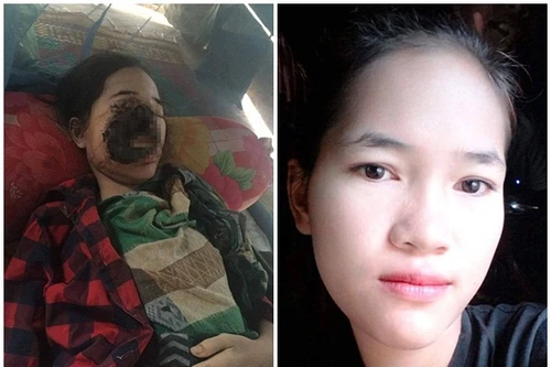 Cô gái xinh mất nửa mặt vì nhiễm vi khuẩn ăn thịt người