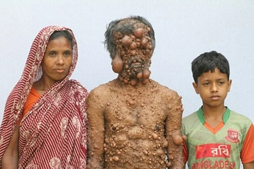 Cuộc sống khổ trăm bề của người đàn ông mọc chi chít khối u