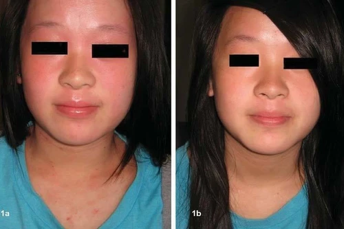 Chữa viêm da dị ứng ở trẻ bằng thảo dược