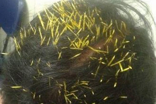 Nhập viện vì bị 200 gai nhím cắm vào đầu
