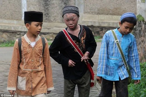 Cậu bé "người rắn" cứ 41 ngày phải "lột da" một lần