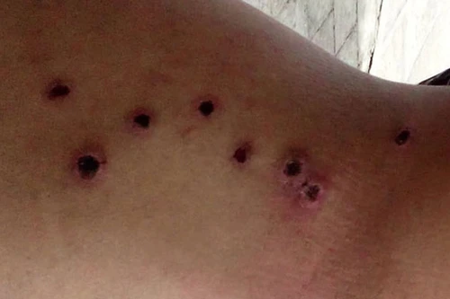 Dùng súng hoa cải bắn người thủng chi chít