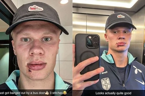 Haaland phải khâu 3 mũi ở miệng vì tai nạn hy hữu