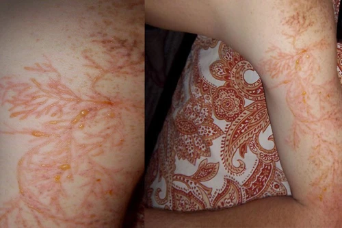 [ẢNH] Bí ẩn hiện tượng "hoa sét" xuất hiện trên cơ thể sau khi bị sét đánh trúng