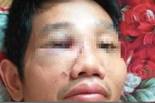 [Tin nhanh tối 7-6-2021] Đang làm rõ vụ cán bộ bị đánh gãy mũi vì mâu thuẫn tại chốt kiểm dịch