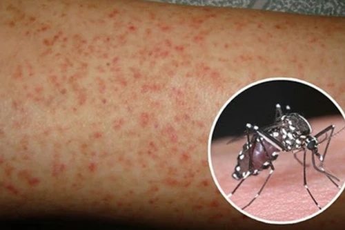 [CLIP] Những mối nguy hiểm khi tự điều trị sốt xuất huyết tại nhà