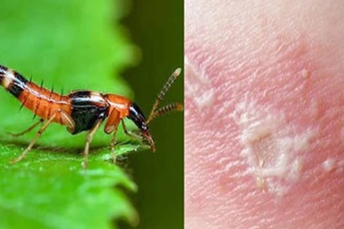 [CLIP] Những cách xử lý nhanh khi bị kiến ba khoang ‘tấn công’