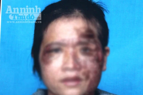 Người phụ nữ bị chồng bạo hành vì tham gia bán hàng đa cấp?