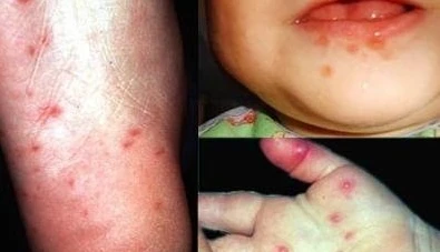 Sớm dập ổ dịch tay chân miệng