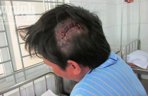 Côn đồ vô cớ vác kiếm chém người nhập viện