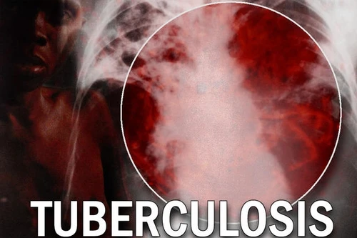 Báo động tình trạng lao kháng thuốc tại châu Âu