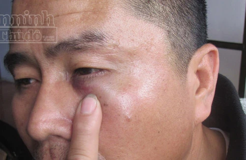 Tranh giành khách, gọi côn đồ đánh dằn mặt tài xế