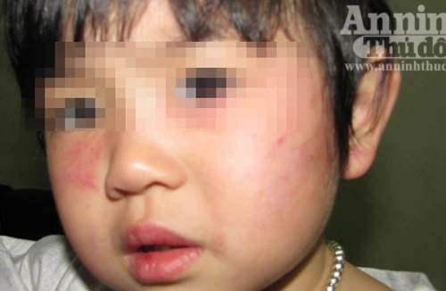 Cô giáo mầm non dùng thước đánh vào mặt trẻ 2 tuổi