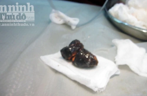 Cụ bà 77 tuổi bị dị vật "kết tinh" dài 6 cm mắc trong tá tràng