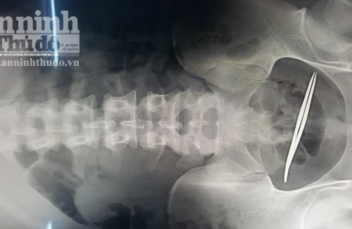 Nam thanh niên nuốt kẹp sắt dài 12cm vào bụng