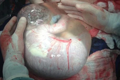 Kỳ lạ bé sơ sinh sinh ra vẫn nằm trong túi ối