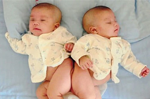 Tách cặp song sinh dính liền bằng công nghệ 3D