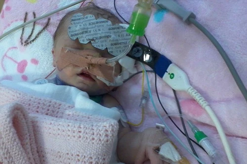 Bé sơ sinh nhỏ tuổi nhất thế giới được phẫu thuật tim