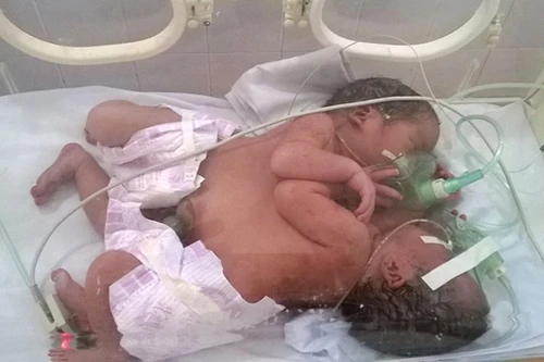 Tặng Bằng khen bác sĩ kêu gọi quyên góp ủng hộ 2 bé sơ sinh dính liền nhau