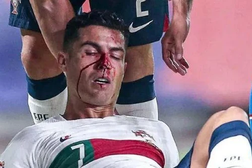 Ronaldo mặt đầm đìa máu trong chiến thắng của ĐT Bồ Đào Nha