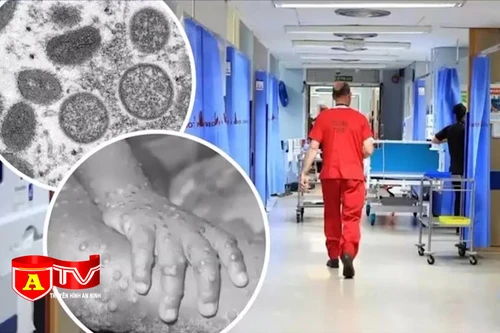 Bệnh đậu mùa khỉ: Không hoang mang nhưng tuyệt đối không chủ quan