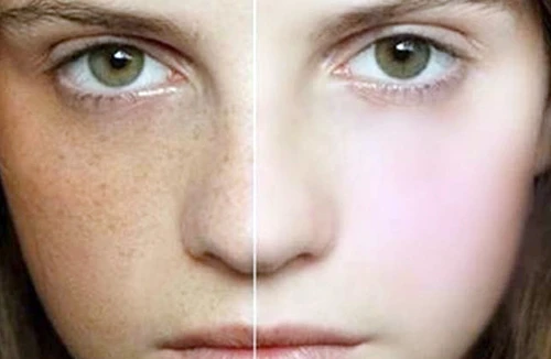 Thực phẩm trị tàn nhang