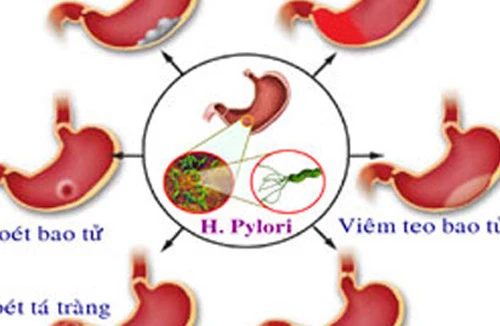 Những tác nhân gây ung thư