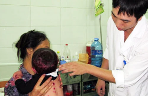 Hà Nội: Bệnh thủy đậu vào mùa