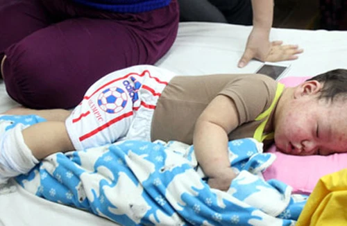 Cách nhận biết và phòng ngừa bệnh sởi