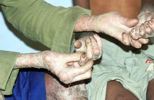 Hai cha con người rắn 47 năm chịu đựng căn bệnh quái ác