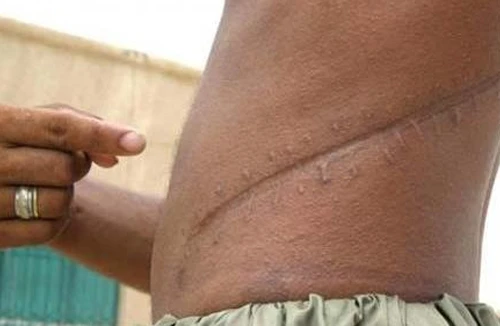 Gia tăng những vụ buôn bán nội tạng người khét tiếng và tàn bạo