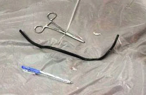 Thách đố nhau, nuốt sợi dây điện gần 40cm