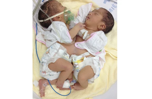 Hai trẻ sơ sinh dính nhau phần bụng