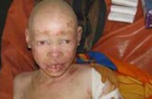 Gia tăng nạn sát hại người bị bệnh bạch tạng để cầu may