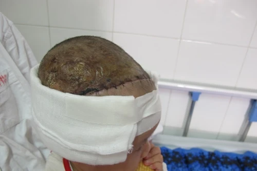Bị lột toàn bộ da đầu sau tai nạn giao thông, bé gái 2 tuổi được cứu sống