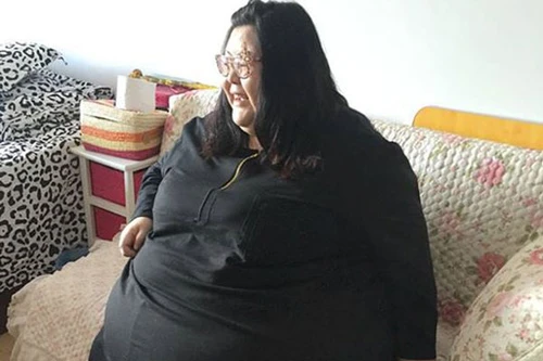 Thắt dạ dày để giảm cân