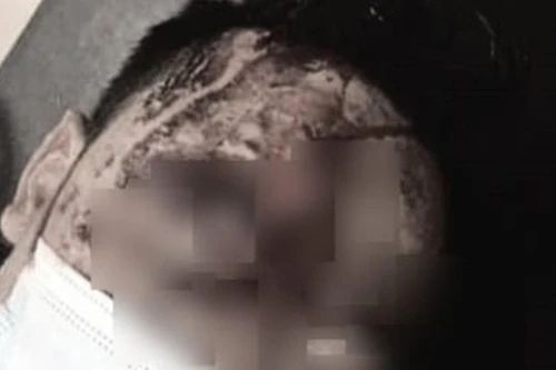 Mâu thuẫn cá nhân, anh rể đánh em vợ nhập viện