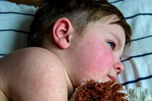 Dịch sởi đang gia tăng ảnh hưởng đến trẻ em trong độ tuổi đi học tại Mỹ