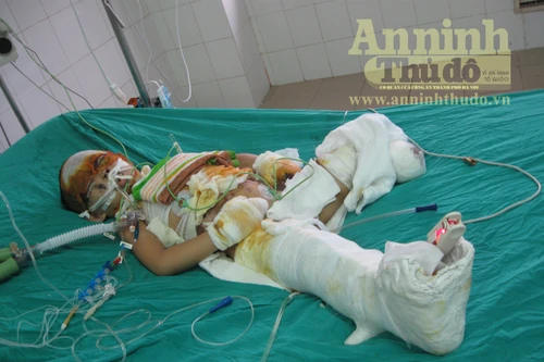 Vụ nổ xe máy kinh hoàng: Bé Vân được đưa về quê vì quá nguy kịch