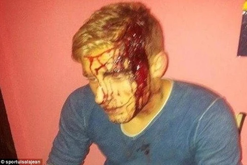 Một cầu thủ bị chém trọng thương bằng rìu