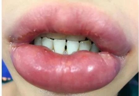 Nguy cơ mất Tết do làm đẹp "cấp tốc"