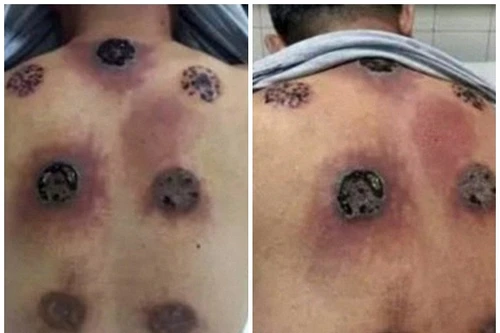 Rùng mình cảnh lưng bị nhiễm trùng nặng vì giác hơi sai cách