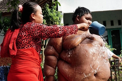 Cuộc sống "đến thở cũng khó" của cậu bé 10 tuổi nặng 192kg