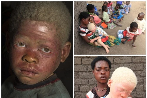 Nỗi ám ảnh của người mẹ có con bị chặt đầu vì nạn "săn người bạch tạng"