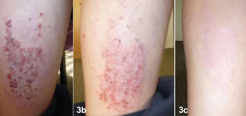 Điều trị viêm da cơ địa mạn tính 