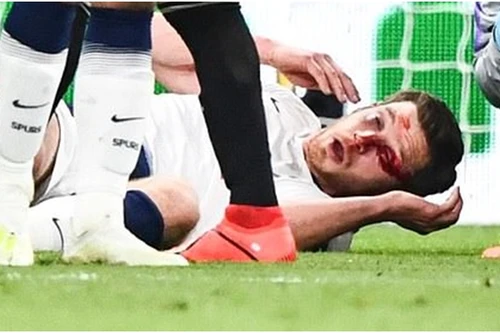 [ẢNH] Rợn người hình ảnh sao Tottenham nằm sân với khuôn mặt đầm đìa máu